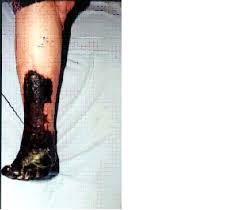 Sigara  Içen  Ve  Içmeyenlerin  Akciğer  Resimleri Iyi  Bakın Hayret  Edin