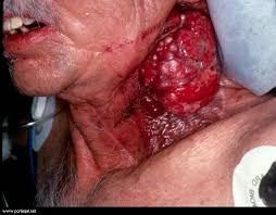 Sigara  Içen  Ve  Içmeyenlerin  Akciğer  Resimleri Iyi  Bakın Hayret  Edin